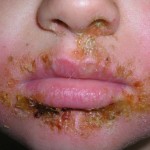 impetigo1