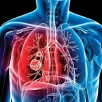 Tuberculosis