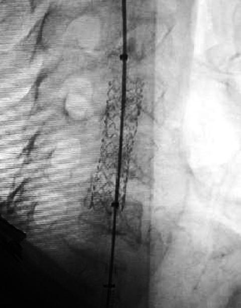 Figura 2. Colocación de stet recubierto. Autor: Unidad de terapia endovascular del Cimeq.