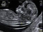 Entrenamiento en Ultrasonografía básica en Ginecología y Obstetricia