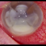 Úlcera corneal