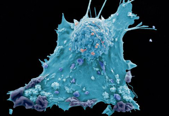célula cancerosa de mama