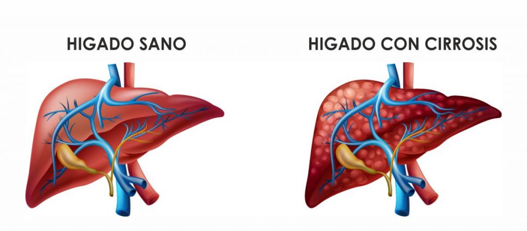 cirrosis del higado vs higado sano